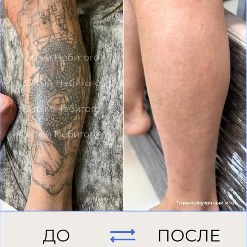 Удаление татуировки